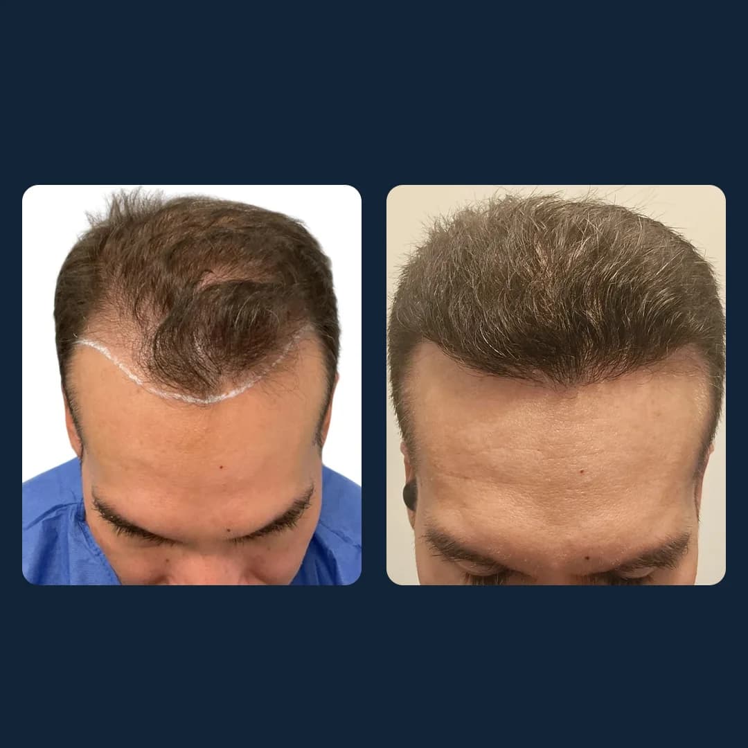 Antes y después de un tratamiento capilar: línea frontal recuperada