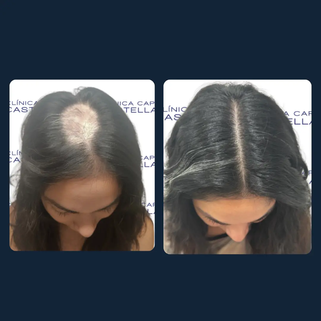Alopecia Areata: causas, síntomas y tratamiento con la Dra. Rivero
