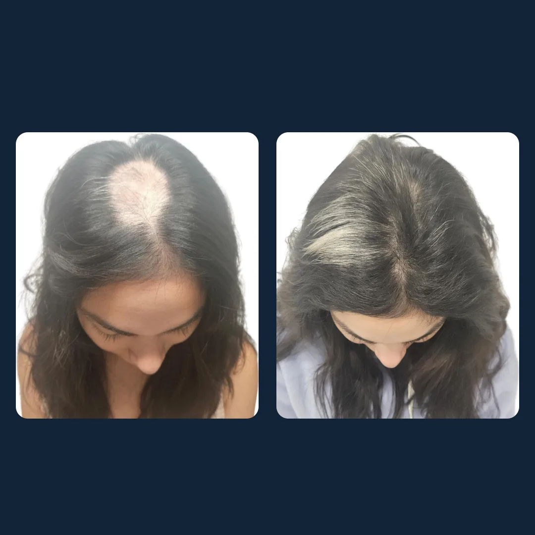 Antes y después de una mesoterapia capilar: densidad recuperada en la coronilla
