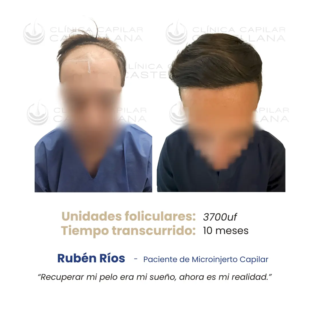 Caso de microinjerto capilar — Rubén Ríos, 3.700 UF, 10 meses