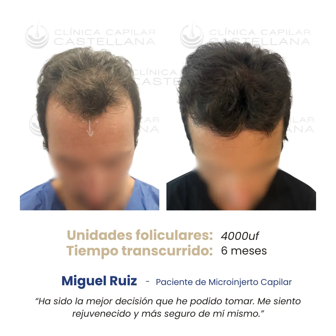 Caso de microinjerto capilar — Miguel Ruiz, 4.000 UF, 6 meses