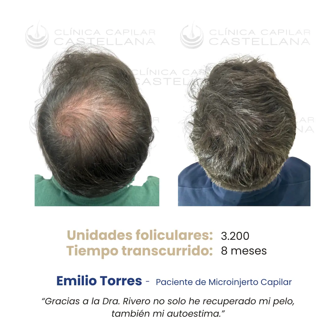Caso de microinjerto capilar — Emilio Torres, 3.200 UF, 8 meses