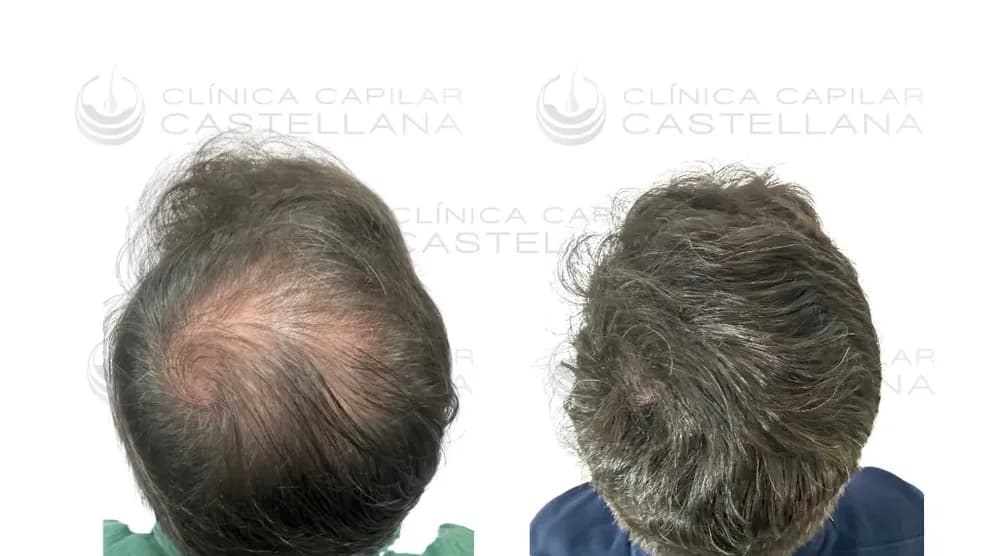 Antes y después de un injerto capilar masculino