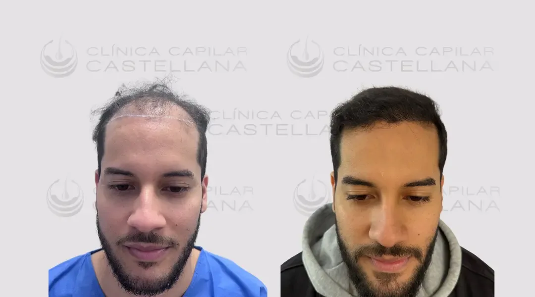 Resultado real de injerto capilar masculino