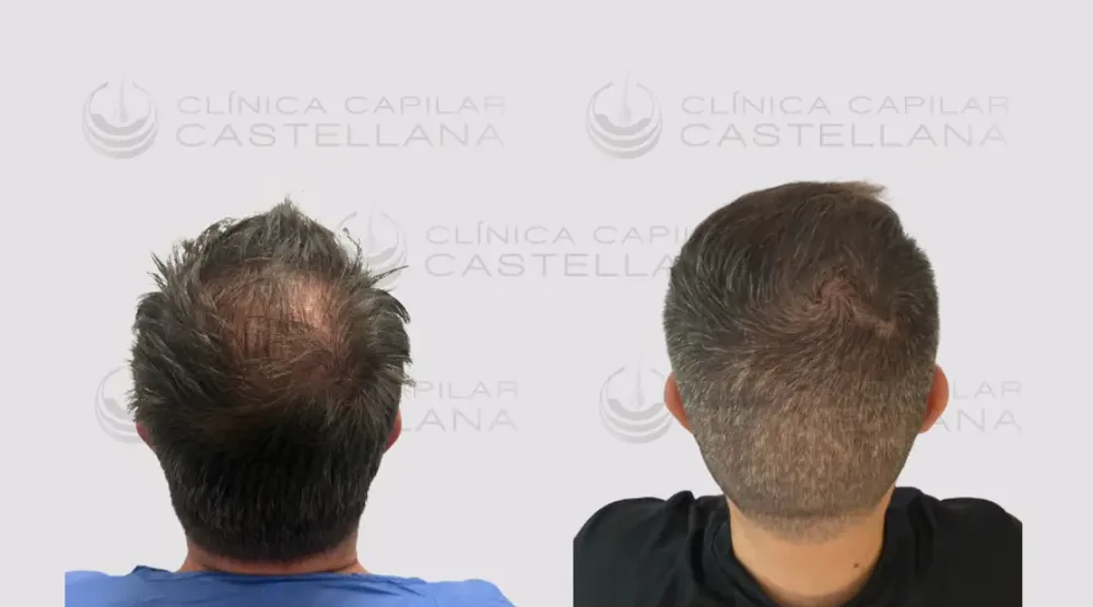 Antes y después de Andrés Martínez — microinjerto capilar, 3.200 UF, 4 meses