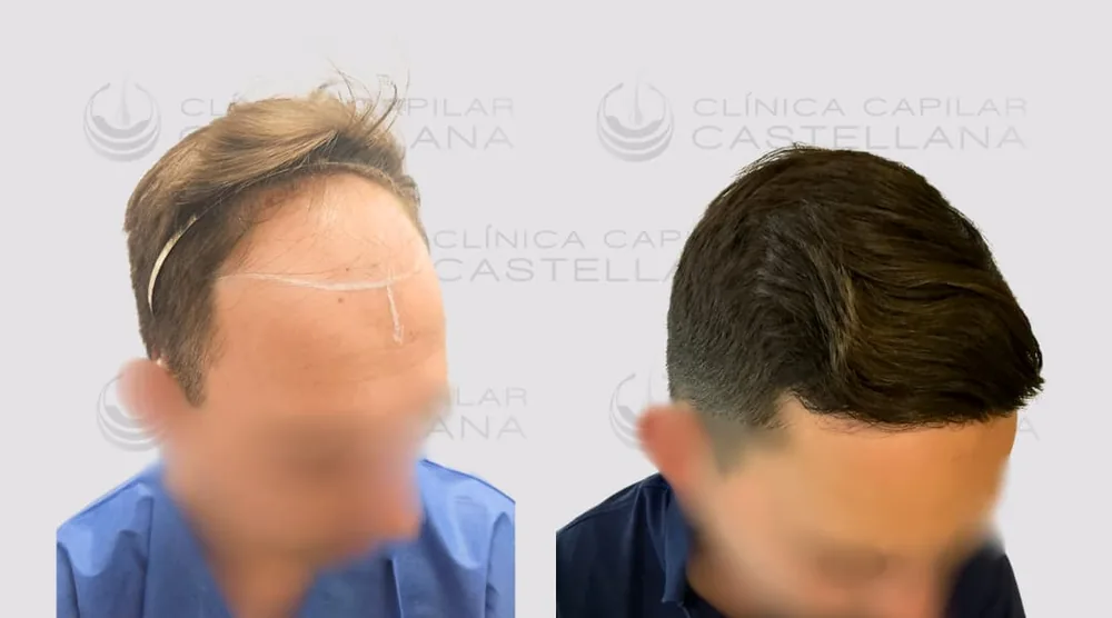 Antes y después de Rubén Ríos — microinjerto capilar, 3.700 UF, 10 meses