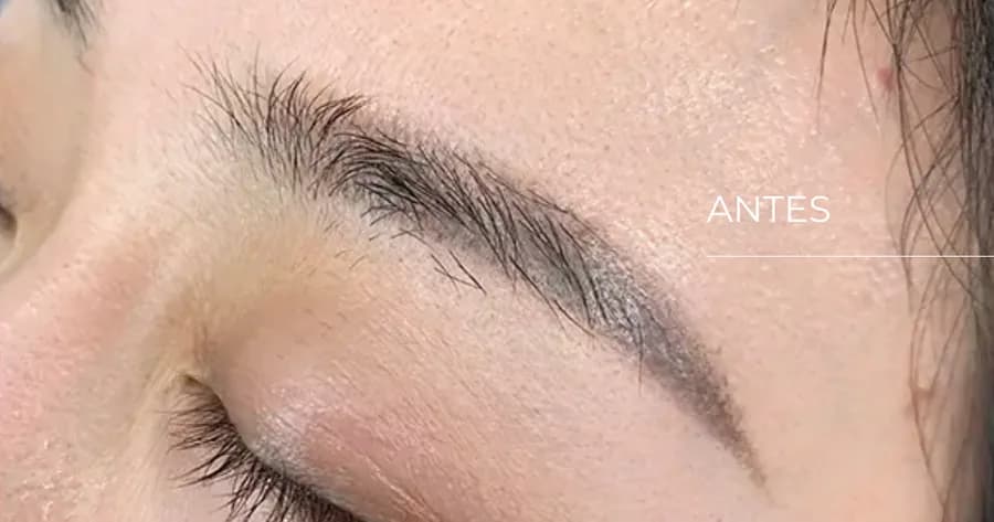 Cejas antes del microinjerto