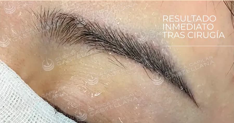 Cejas después del microinjerto