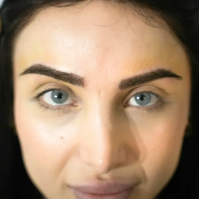 Resultado de microinjerto de cejas