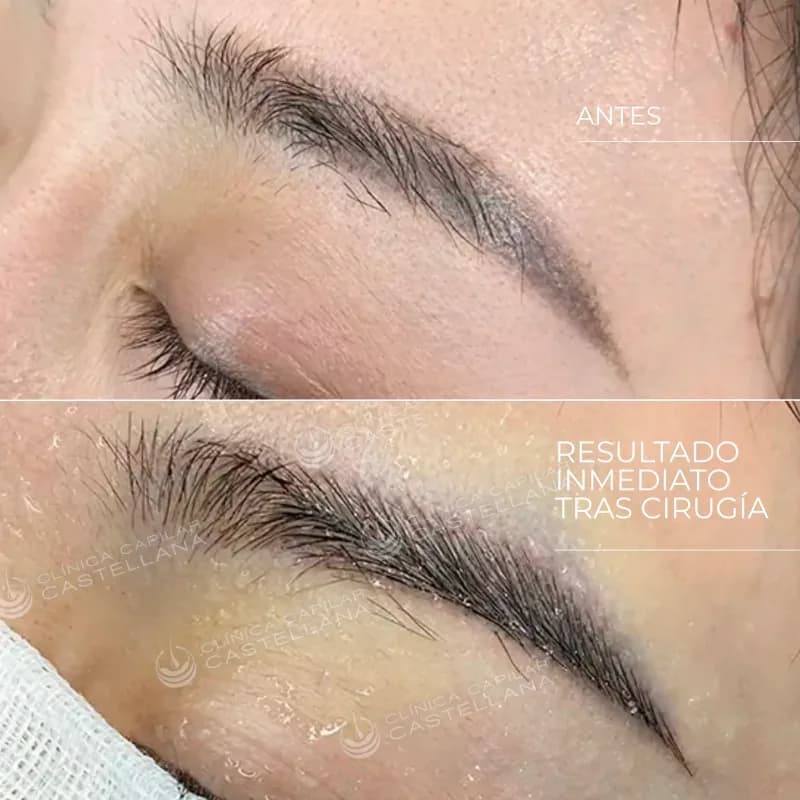 Cejas antes y después