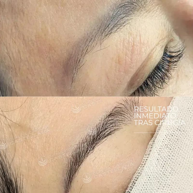 Cejas antes y después