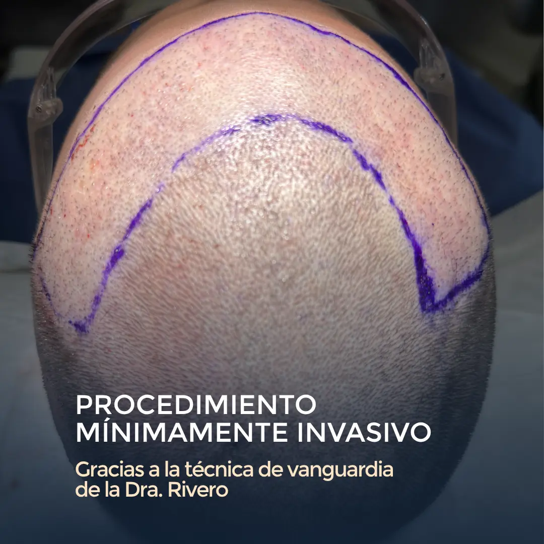 El arte del diseño capilar: por qué un buen injerto no debe notarse